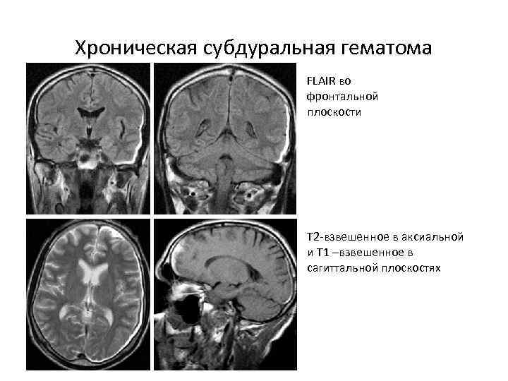 Т2 взвешенное изображение