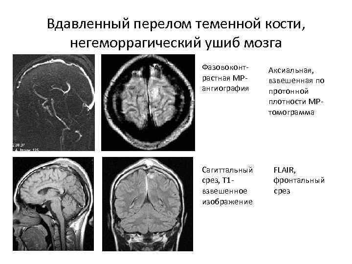 Изображение взвешенное по протонной плотности