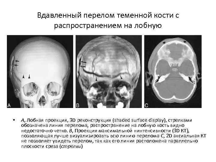 Перелом теменной кости у грудного