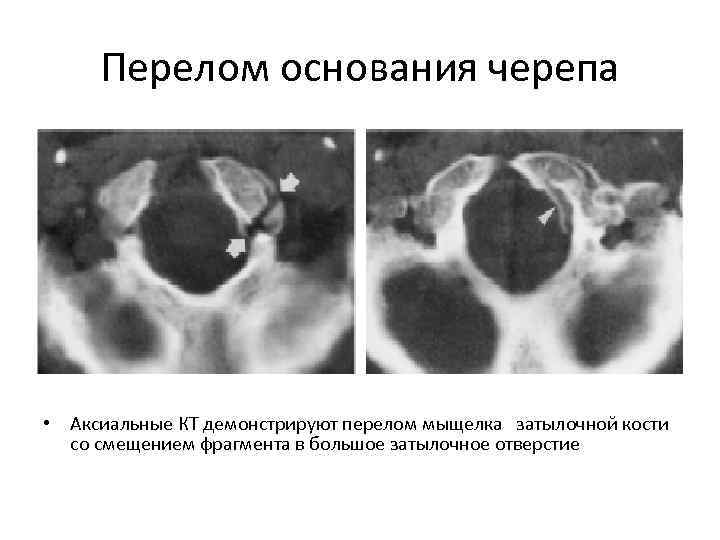 Типичное проявление перелома основания черепа