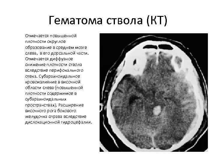 Перифокальный отек мозга