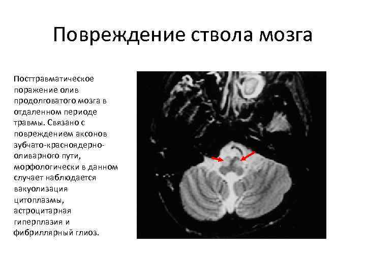 Повреждения головного мозга возникают. Ушиб ствола головного мозга последствия. Поражение ствола головного мозга. Повреждение продолговатого мозга. Повреждение ствола мозга.