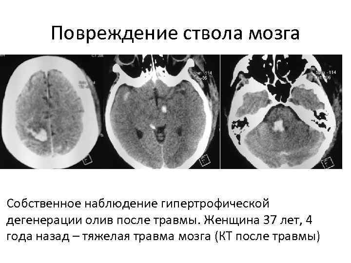 Повреждение ствола мозга. Повреждение ствола головного мозга симптомы. Повреждение ствола головного мозга последствия. Признаки повреждения ствола головного мозга.