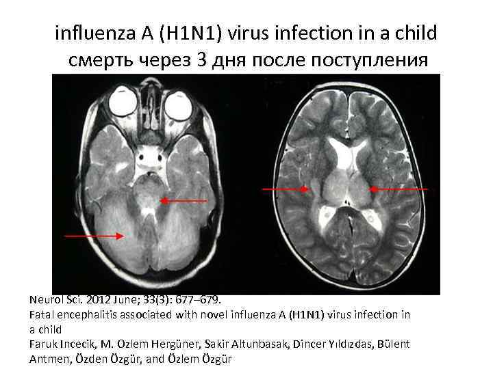 influenza A (H 1 N 1) virus infection in a child смерть через 3