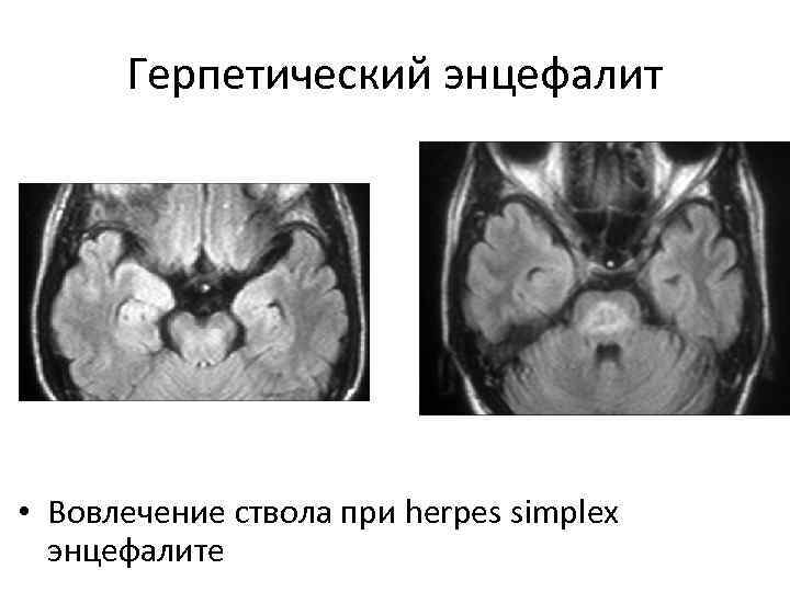 Герпетический энцефалит • Вовлечение ствола при herpes simplex энцефалите 