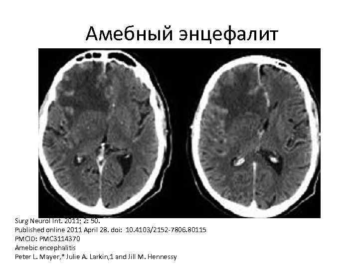 Амебный энцефалит Surg Neurol Int. 2011; 2: 50. Published online 2011 April 28. doi: