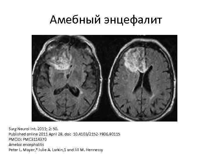 Энцефалит головного мозга у взрослых