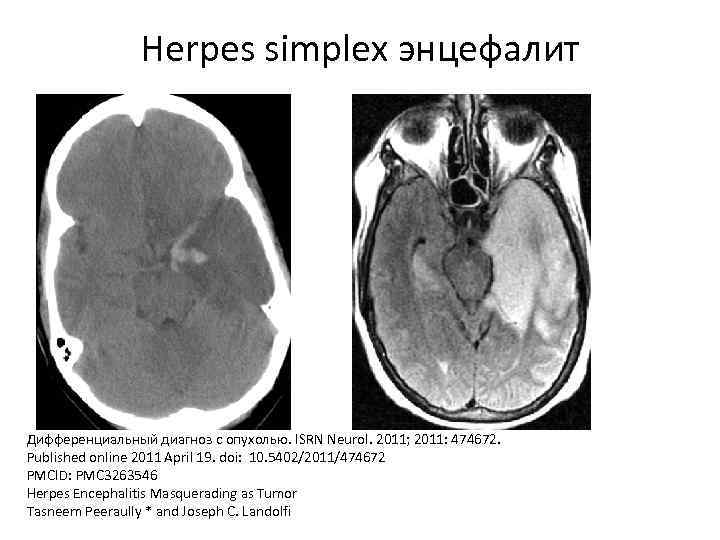Herpes simplex энцефалит Дифференциальный диагноз с опухолью. ISRN Neurol. 2011; 2011: 474672. Published online
