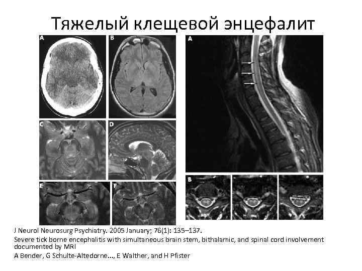 Тяжелый клещевой энцефалит J Neurol Neurosurg Psychiatry. 2005 January; 76(1): 135– 137. Severe tick