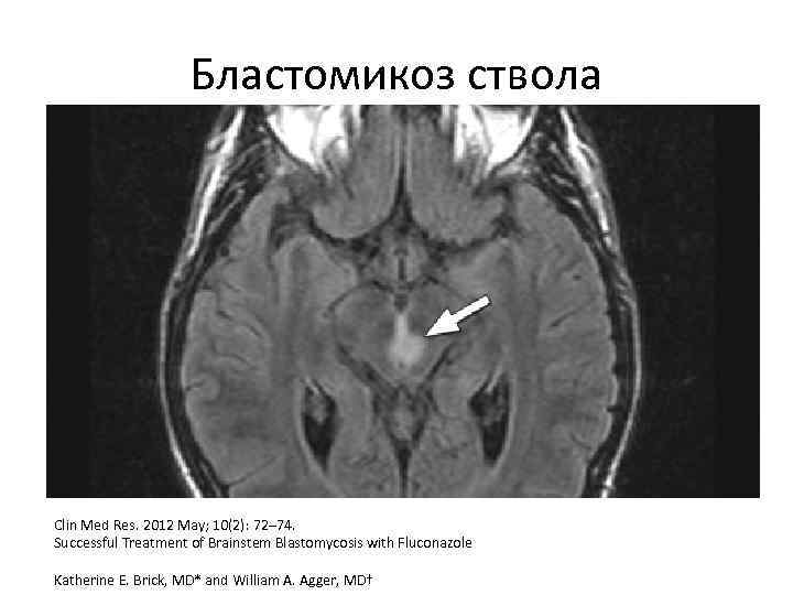 Бластомикоз ствола Clin Med Res. 2012 May; 10(2): 72– 74. Successful Treatment of Brainstem