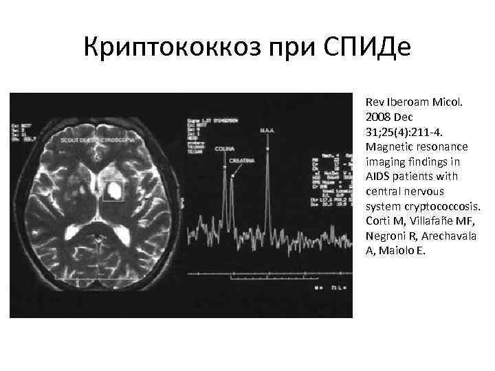 Криптококкоз при СПИДе Rev Iberoam Micol. 2008 Dec 31; 25(4): 211 -4. Magnetic resonance