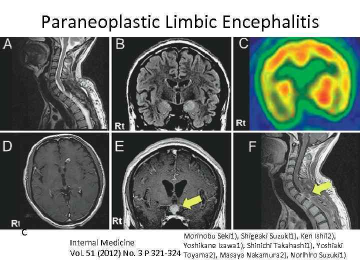 Paraneoplastic Limbic Encephalitis с Morinobu Seki 1), Shigeaki Suzuki 1), Ken Ishii 2), Internal