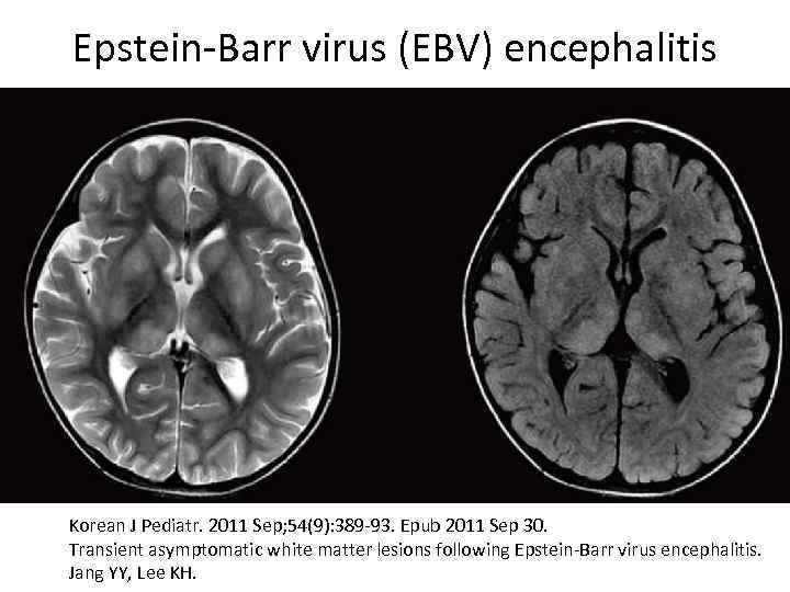 Epstein-Barr virus (EBV) encephalitis Korean J Pediatr. 2011 Sep; 54(9): 389 -93. Epub 2011