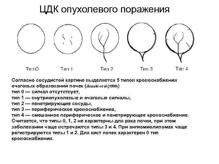 ЦДК опухолевого поражения Согласно сосудистой картине выделяется 5 типов кровоснабжения очаговых образований почек (Jinzaki