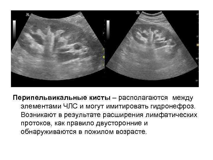 Перипельвикальные кисты – располагаются между элементами ЧЛС и могут имитировать гидронефроз. Возникают в результате