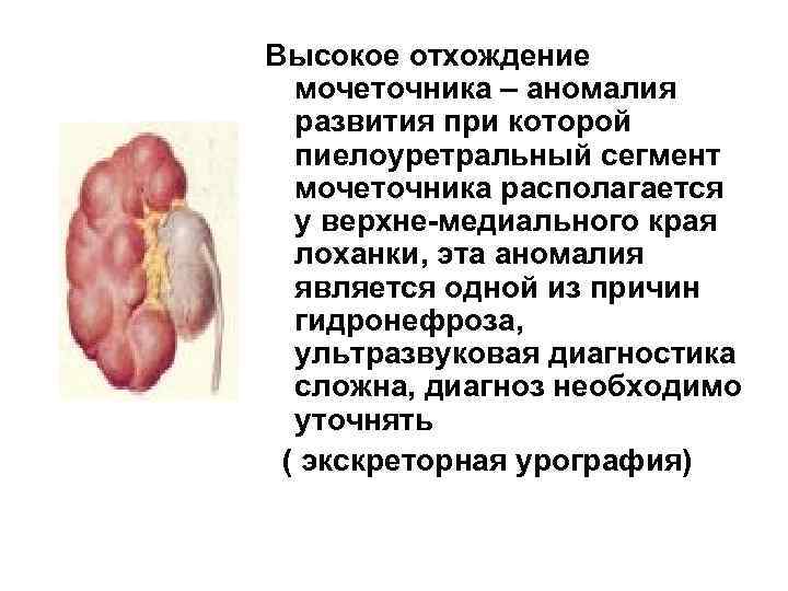 Высокое отхождение мочеточника – аномалия развития при которой пиелоуретральный сегмент мочеточника располагается у верхне-медиального
