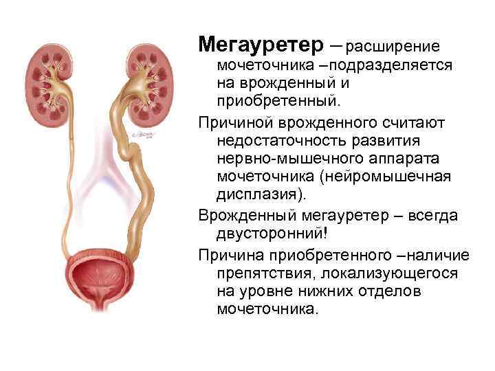 Мегауретер – расширение мочеточника –подразделяется на врожденный и приобретенный. Причиной врожденного считают недостаточность развития