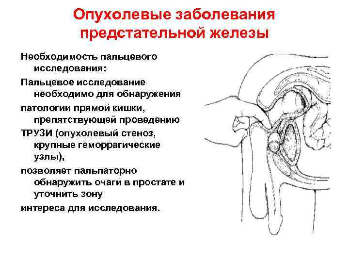 Опухолевые заболевания предстательной железы Необходимость пальцевого исследования: Пальцевое исследование необходимо для обнаружения патологии прямой