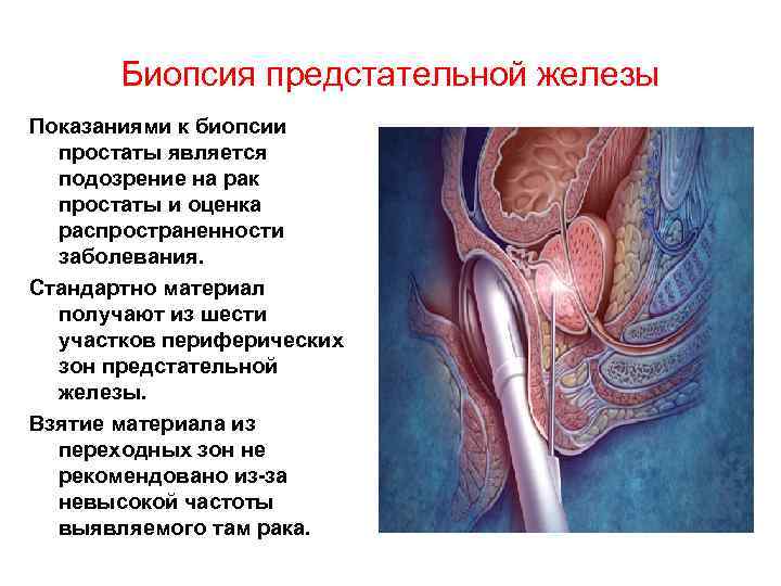 Биопсия предстательной железы Показаниями к биопсии простаты является подозрение на рак простаты и оценка