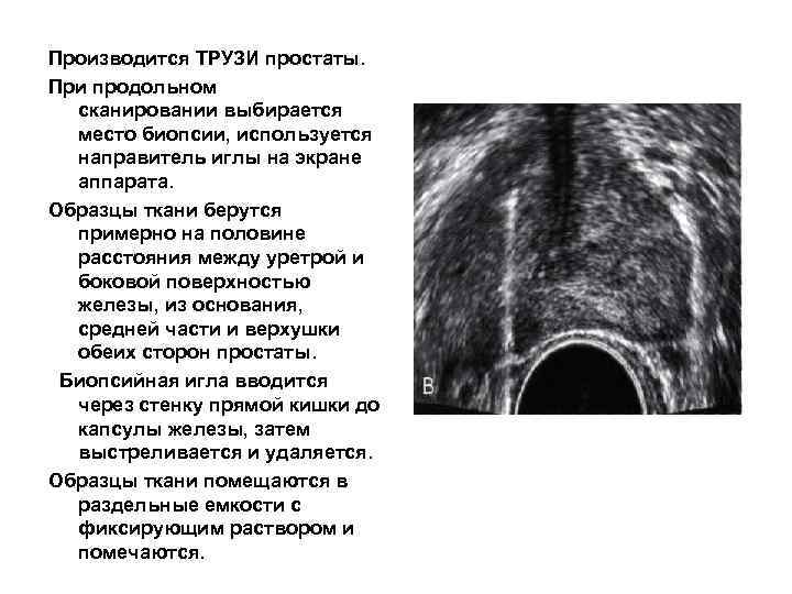 Производится ТРУЗИ простаты. При продольном сканировании выбирается место биопсии, используется направитель иглы на экране