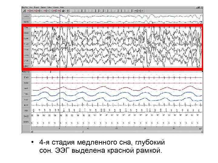  • 4 я стадия медленного сна, глубокий сон. ЭЭГ выделена красной рамкой. 