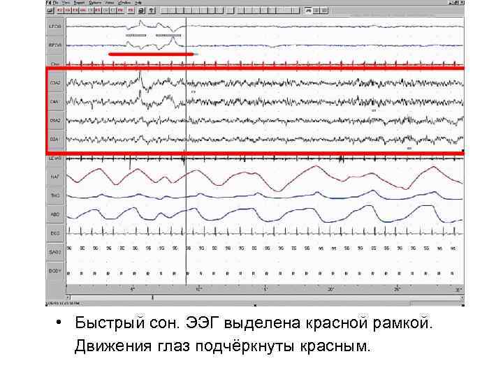 • Быстрый сон. ЭЭГ выделена красной рамкой. Движения глаз подчёркнуты красным. 