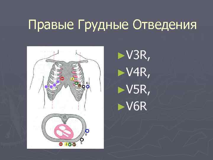 Правые Грудные Отведения ►V 3 R, ►V 4 R, ►V 5 R, ►V 6
