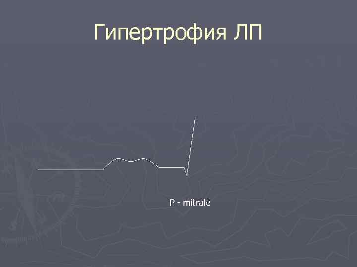 Гипертрофия ЛП Р - mitrale 