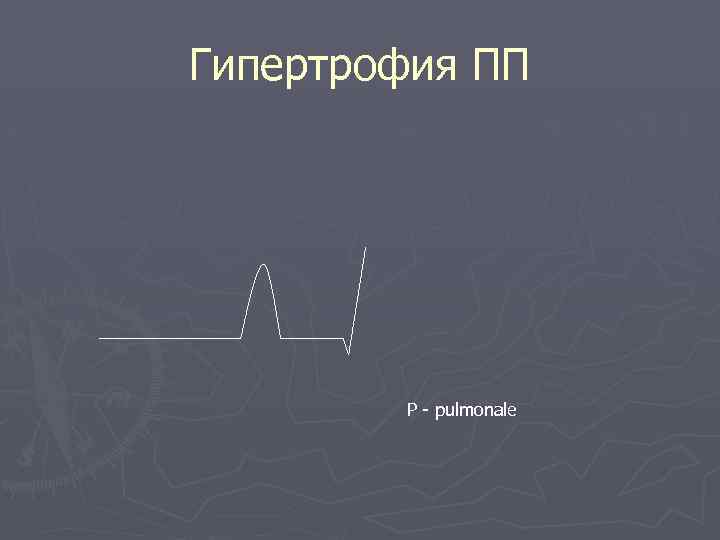 Гипертрофия ПП Р - pulmonale 