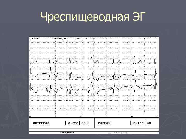 Чреспищеводная ЭГ 