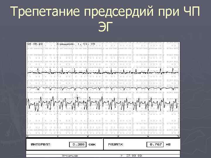 Трепетание предсердий при ЧП ЭГ 