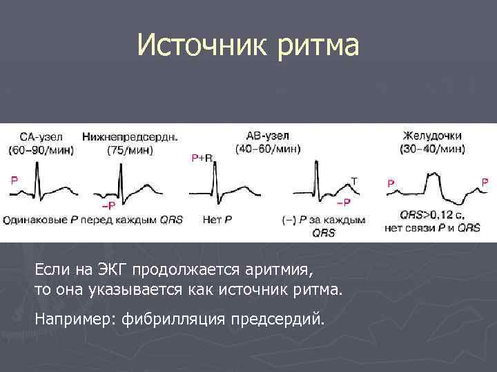 Источник ритма Если на ЭКГ продолжается аритмия, то она указывается как источник ритма. Например: