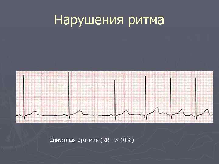 Нарушения ритма Синусовая аритмия (RR - > 10%) 