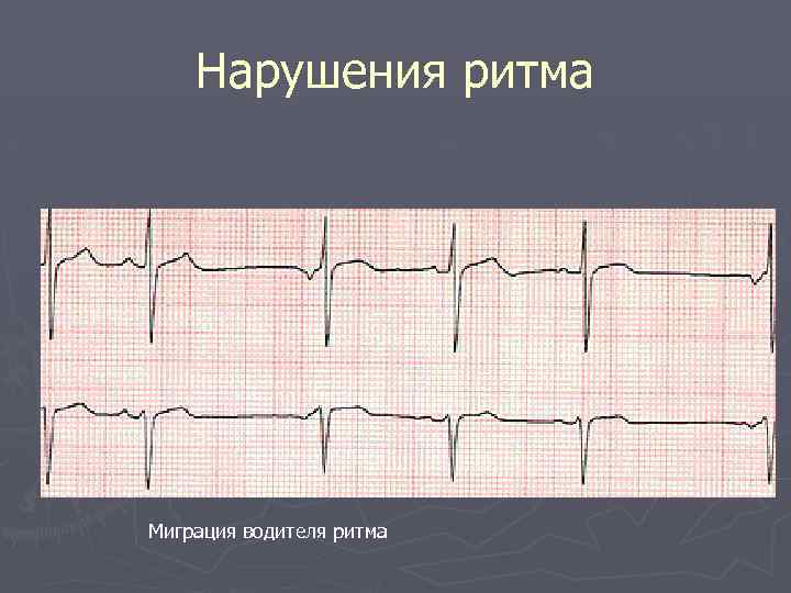 Нарушения ритма Миграция водителя ритма 