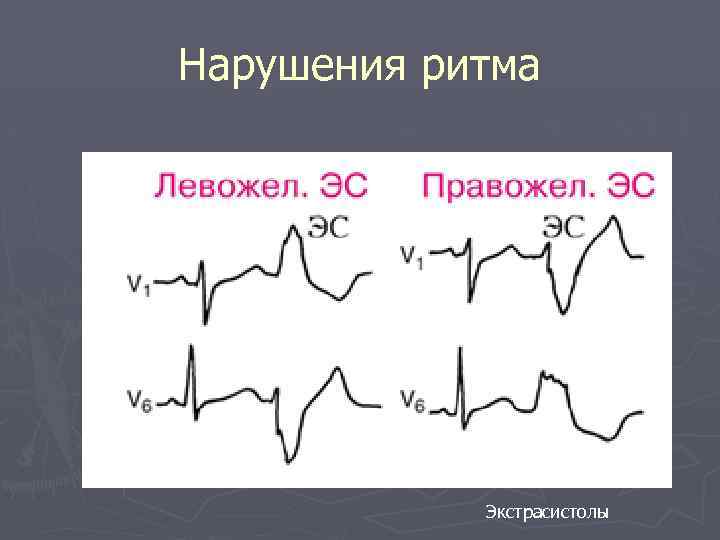 Нарушения ритма Экстрасистолы 