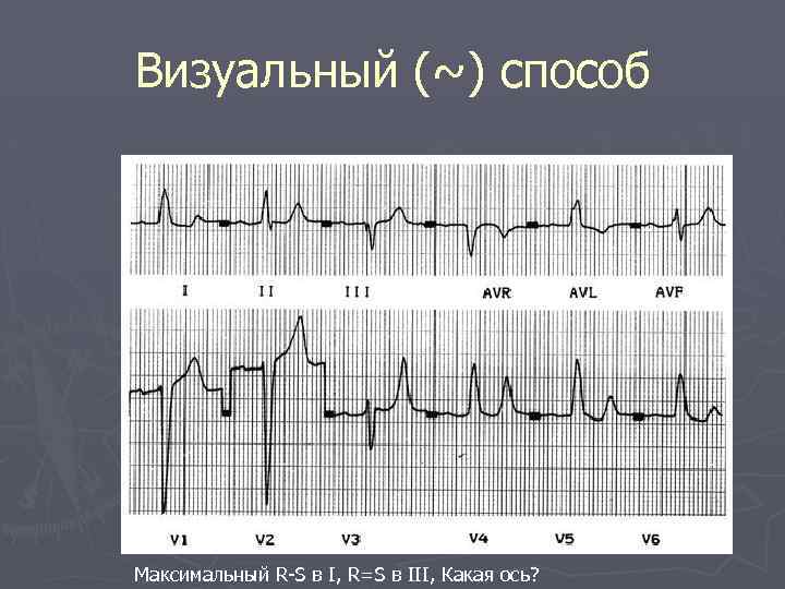 Визуальный (~) способ Максимальный R-S в I, R=S в III, Какая ось? 