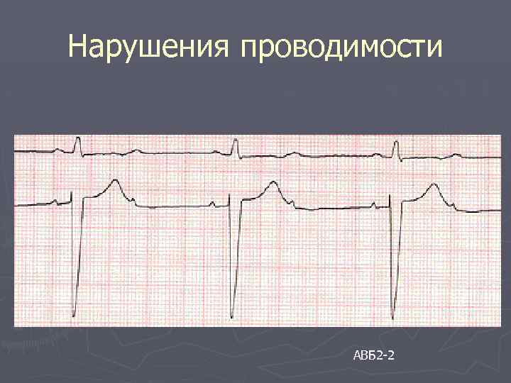 Нарушения проводимости АВБ 2 -2 