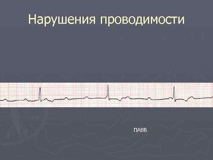 Нарушения проводимости ПАВБ 