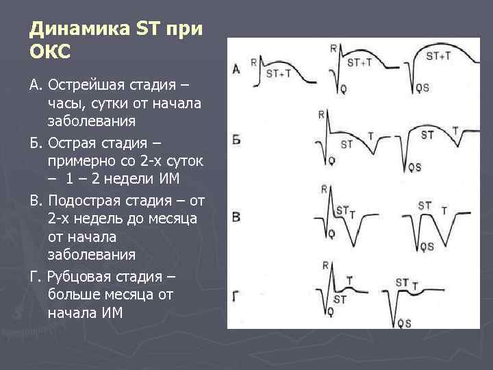 Динамика ST при ОКС А. Острейшая стадия – часы, сутки от начала заболевания Б.