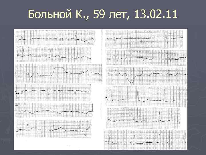 Больной К. , 59 лет, 13. 02. 11 