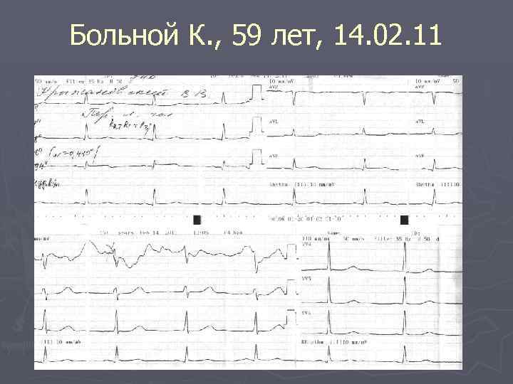 Больной К. , 59 лет, 14. 02. 11 
