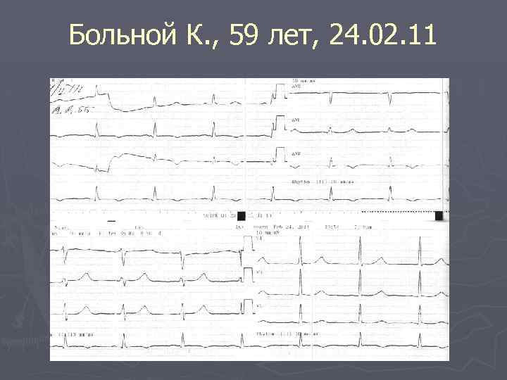 Больной К. , 59 лет, 24. 02. 11 