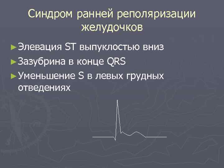 Синдром ранней реполяризации желудочков ► Элевация ST выпуклостью вниз ► Зазубрина в конце QRS