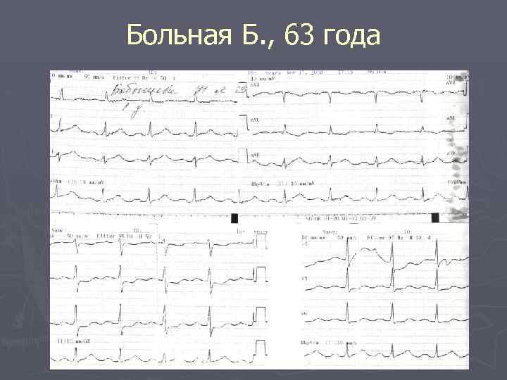 Больная Б. , 63 года 