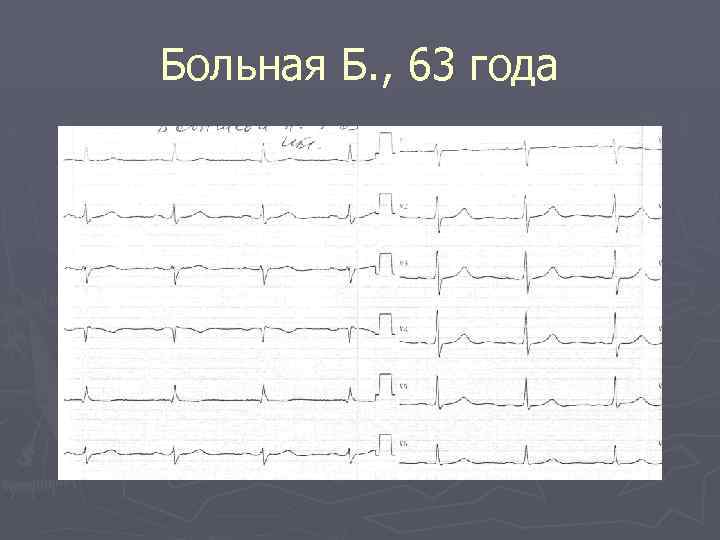 Больная Б. , 63 года 