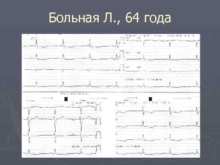 Больная Л. , 64 года 