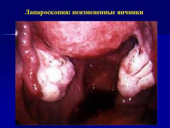 Лапароскопия: неизмененные яичники 