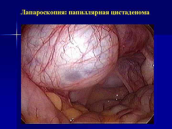 Лапароскопия: папиллярная цистаденома 