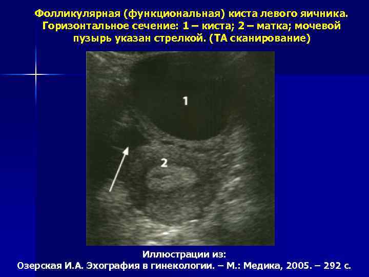 Фолликулярная (функциональная) киста левого яичника. Горизонтальное сечение: 1 – киста; 2 – матка; мочевой