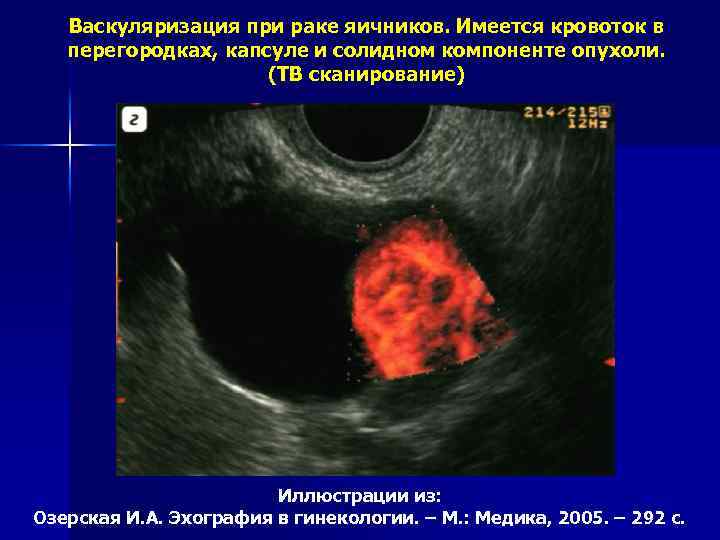 Опухоль на яичнике у женщин